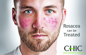  روزاسه بيماري شايع پوستي است كه سبب قرمزي و تورم صورت مي شود.