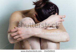 مبتلا به بیماری برص