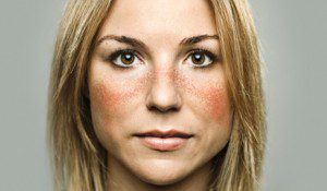 تفاوت اگزما و لوپوس