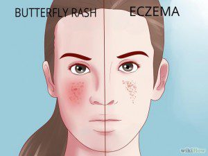 اگزما یا لوپوس؟