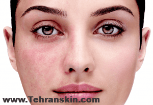  آکنه‌ روزاسه‌ 