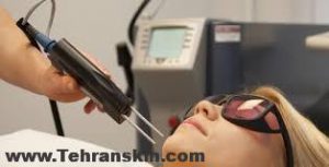 لیزر الکساندریت