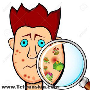 باور غلط پنجم: آکنه بعلت وجود آلودگی های موجود بر سطح پوست رخ می دهد.