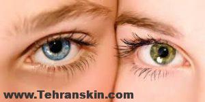 چین و چروک اطراف چشم