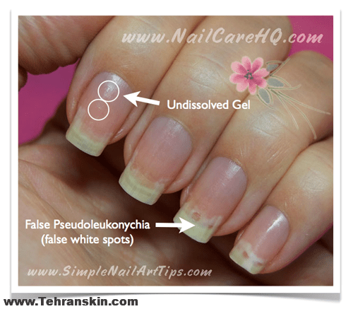 لکه هاي سفيد روي ناخن يک مشکل شايع