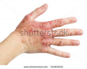 کاهش علائم اگزما با روغن گل مغربی