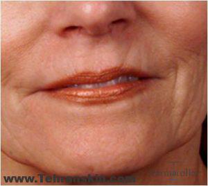 چین و چروک اطراف لب