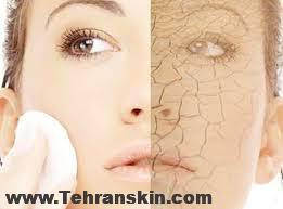 چگونه با چروک های پوستی مقابله کنیم ؟