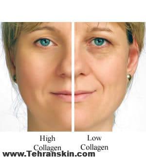 مهمترین عامل کاهش دهنده تولید کلاژن پوست