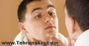 آکنه در مردان