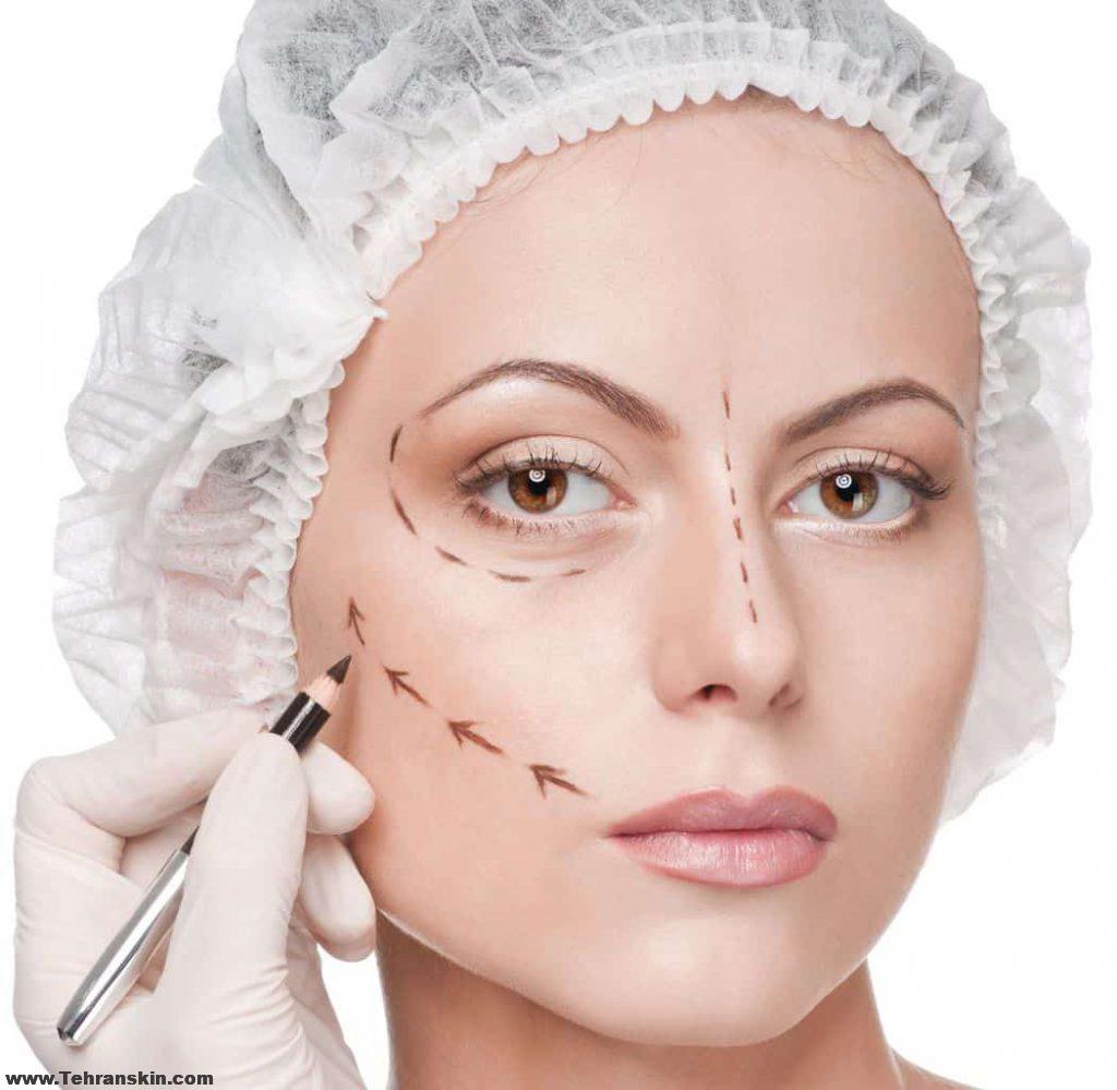 کشیدن پوست صورت با جراحی