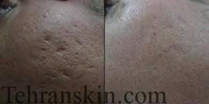 درمان منافذ باز پوست