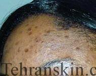 لک جوش صورت 