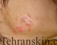 درمان جای جوش