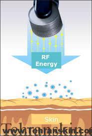 آر اف و انواع آن 