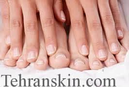 nail psoriasis 1