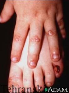 اپیدرمولیز بولوسا