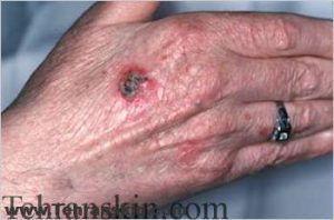 سرطان سلول سنگفرشی