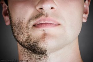 نتیجه تصویری برای لیزر مو های زائد صورت مردان