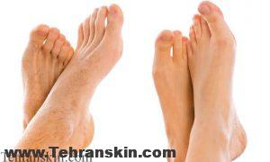 آمادگی برای لیزر1