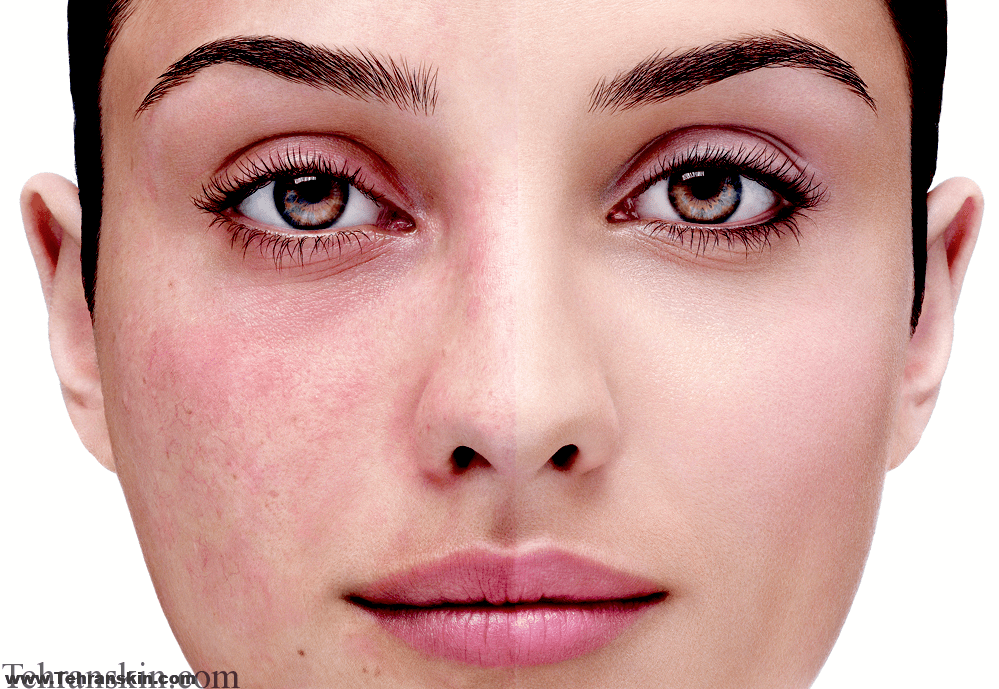 مهمترین لیزر درمان روزاسه