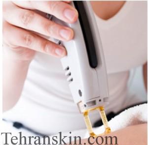 لیزر موهای زائد5