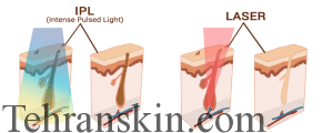 لیزر و IPL