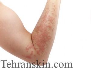 اگزما1