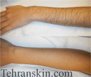 برتری های لیزر