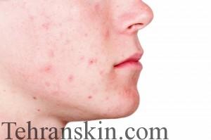 جوش های بزرگسالی