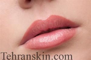 موهای زائد0