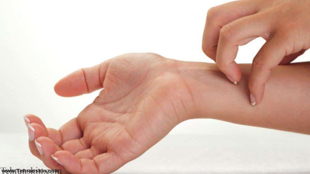 انواع حساسیت های پوستی