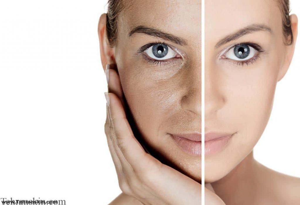 بستن منافذ پوستی با لیزر