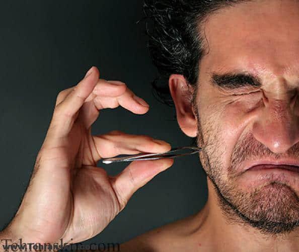 تصویری از موهای زیر پوستی صورت