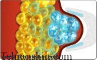 کرایولیپولیز و کویتیشن  _ تفاوت ها