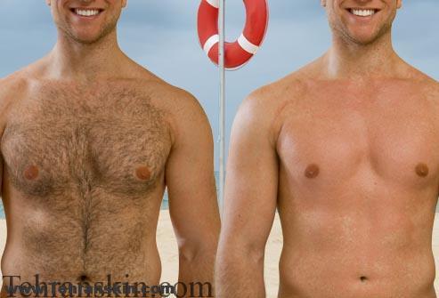 مزایا و معایب لیزر درمانی