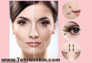 جوانسازی صورت با RF