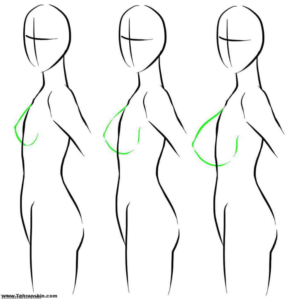 سینه های خوش فرم وسفت با ماموپلاستی کاهنده یا جراحی کوچک کردن سینه