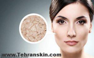 مقابله با خشکی پوست