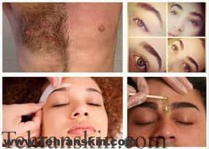 بهترین روش برای رفع موهای زائد کدام است ؟