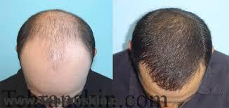 بهترین روش کاشت مو