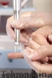 لیزردرمانی برای زگیل