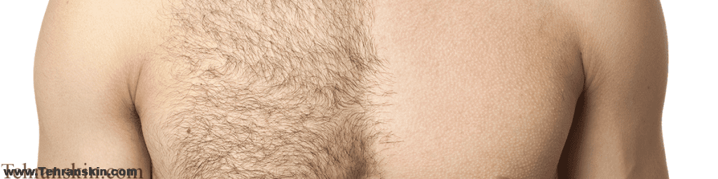 از بین بردن موهای زائد با لیزر