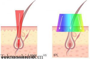 مقایسه لیزر موهای زائد و آی پی ال