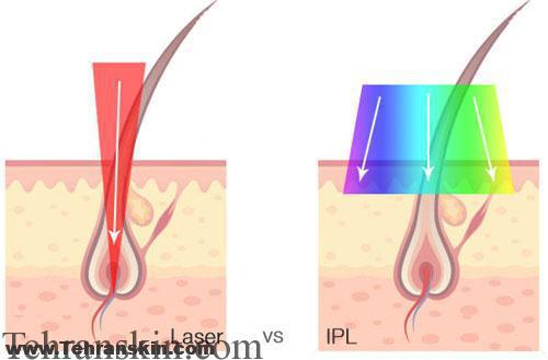 مقایسه لیزر موهای زائد و آی پی ال