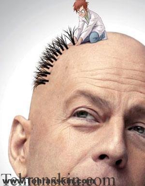 بهترین مزایای جراحی پیوند مو | مزایا و معایب پیوند مو | بهترین مرکز پیوند مو