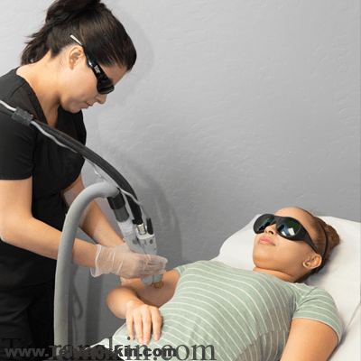 لیزر موهای زائد دست ها