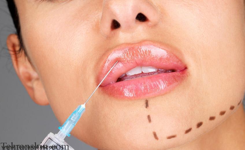 تخفیف ژل خط خنده،لب،گونه،خط اخم و بینی در تهران (محدود)