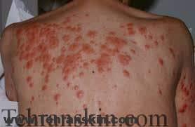 بیماری سندرم شیرین