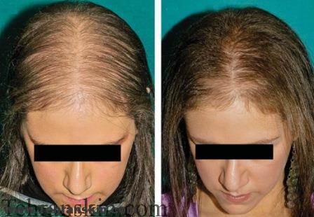 مهمترین علل ریزش مو در خانم ها